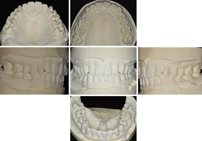 歯模型03